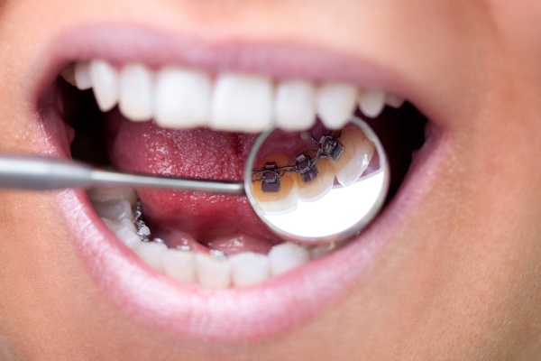 Female patient showing her invisible lingual braces braces on dental mirror