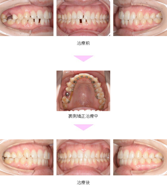 すきっ歯 裏側矯正 インプラント矯正 非抜歯 治療期間1年1か月 港区 30代女性 世田谷 二子玉川 目立たない裏側矯正 裏側矯正専門サイト